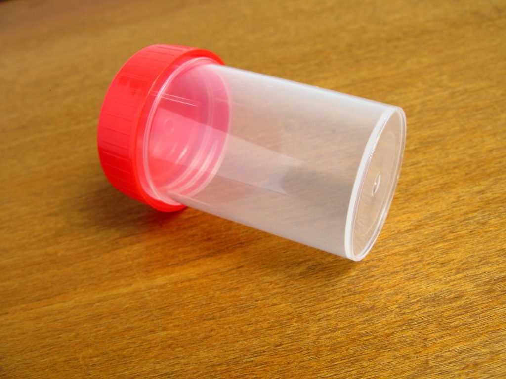 understanding-proteinuria-does-the-presence-of-protein-in-urine
